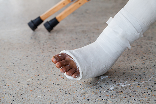 broken leg